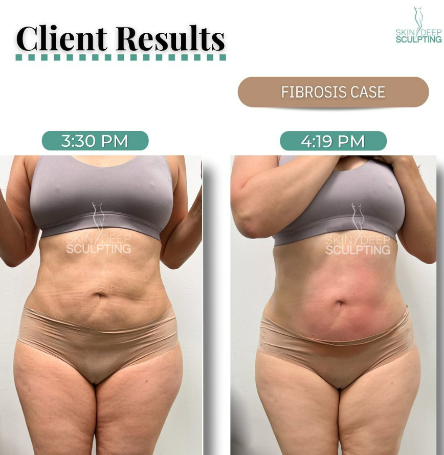 Comparative images of a woman's tummy, illustrating the positive changes achieved through effective fibrosis care